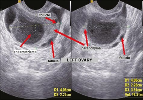 Scielo Brazil Transvaginal Ultrasound In Deep Endometriosis Pictorial Essay Transvaginal