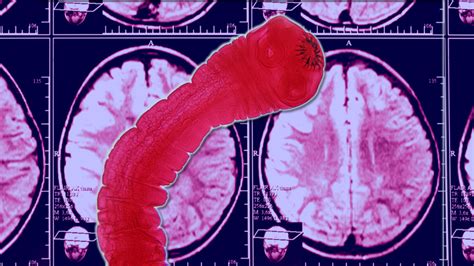 Doctors Shocked After Finding Tapeworm In Mans Brain 6abc Philadelphia