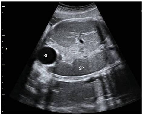 Ultrasound Scan Shows Liver And Spleen Adjacent To Bladder Which