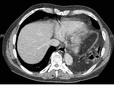 Axial Post Iv Contrast Ct Through The Lower Chestupper Abdomen Showing