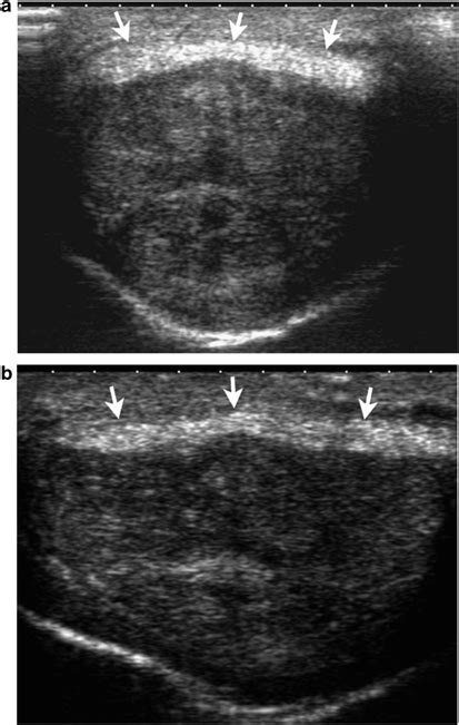 Peyronies Disease Transverse A And Longitudinal B Gray Scale