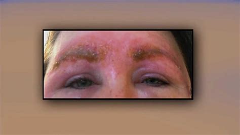 Woman Hospitalized With Potentially Deadly Infection After Popular Eyebrow Procedure