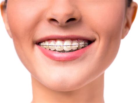 Adult Braces Smile Every Day Orthodontics Of Plantation And Tamarac Fl