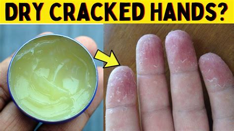 This Home Remedy Is Best For Severely Dry Cracked Hands And Fingers