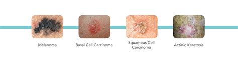 Basal Cell Skin Cancer Prognosis