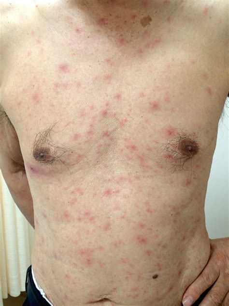 Pink Erythematous Papules 2 5 Mm In Diameter Are Visible On The