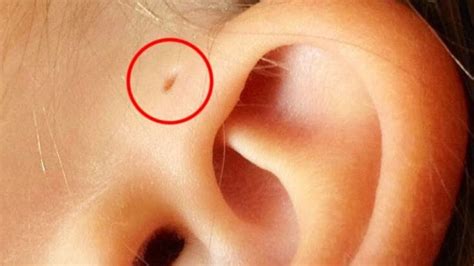 Heres What It Means If You Have A Tiny Hole Above Your Ear Health