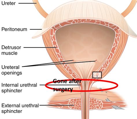 Prognosis Of Recovery From Post Surgery Incontinence After Radical Prostatectomy Progression Of
