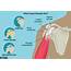Shoulder Pain Causes Treatment And When To See A Healthcare Provider