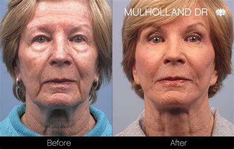Facelift Toronto Facelift Costs And Before After Spamedica