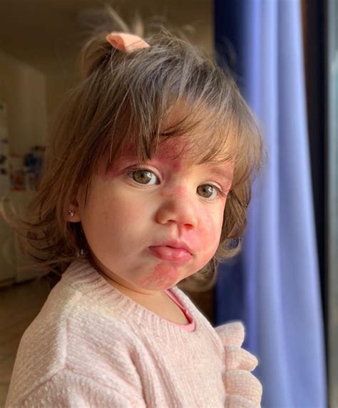 Toddler Bullied Because Of Facial Birthmark Her Mother Speaks Out