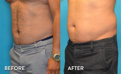 Sculpsure Before And After Pictures Sculpsure Photo Gallery