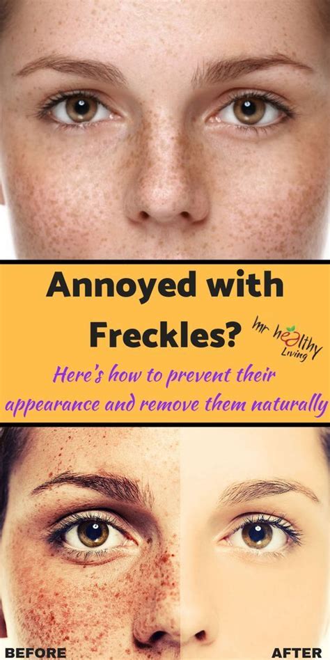 How To Get Rid Of Freckles Naturally And Fast Getting Rid Of Freckles Freckles Freckle Remover
