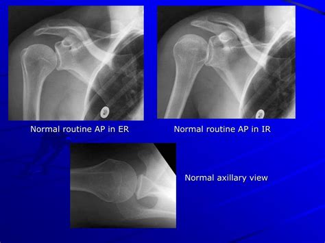 Ppt X Ray Rounds Plain Radiographic Evaluation Of The Shoulder