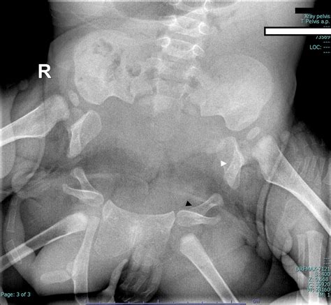 Conjoined Twins At The Pelvis