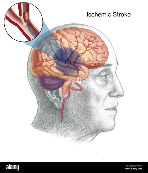 Illustration Showing The Mechanism Of An Ishemic Stroke In An Ischemic