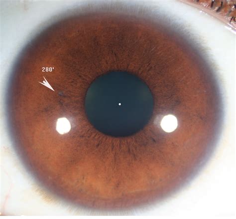 Modern And Multidimensional Iridology Solitary Closed Lacuna In B1 Type