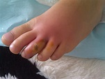 toe infections pictures - pictures, photos