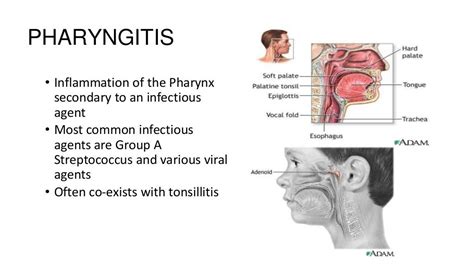 Pharyngitis Laryngitis