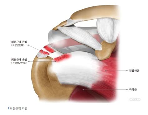 회전근개파열 원인은 어깨관절 내 힘줄 파열 전자신문