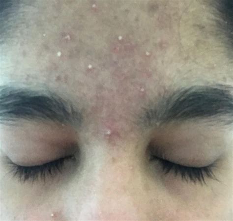 Candida Acne On Forehead