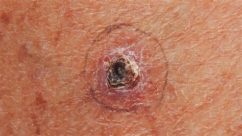 Skin Cancer Signs Treatment Types Of Skin Cancer Melanoma Basal And