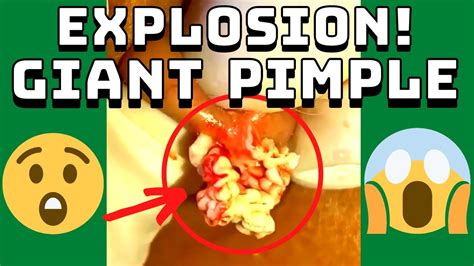 Giant Pimple Explosion Cyst Popping Acne Pus Blackheads Bursting
