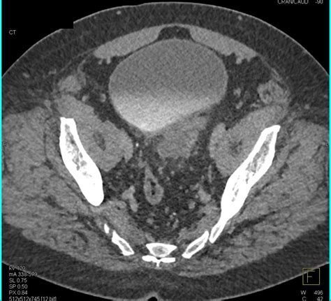 Carcinoma In Left Bladder Diverticulum Genitourinary Case Studies