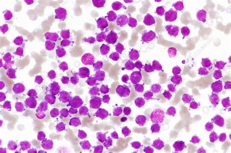 Leukaemia Blood Cells Light Micrograph Stock Image M1321011