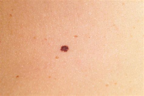 What Does Melanoma Look Like Early Stages Symptoms And Pictures
