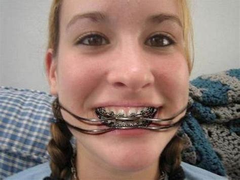 Image Result For Milwaukee Brace Pictures Braces Girls Dental Braces Milwaukee Brace