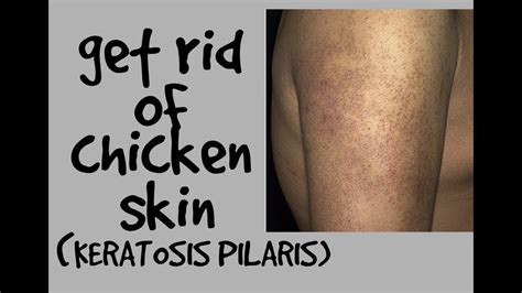 Keratosis Pilaris Arms How To Get Rid