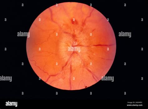Papilloedema Of The Eye Ophthalmoscope Image Papilloedema Is The