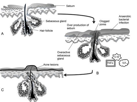 Causative Pathogenic Factors In Acne 1 Pilosebaceous Unit 2