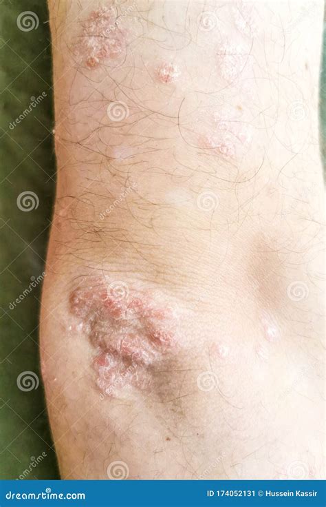 Elbow Skin Psoriasis Disease Problem Stock Image Image Of Cream
