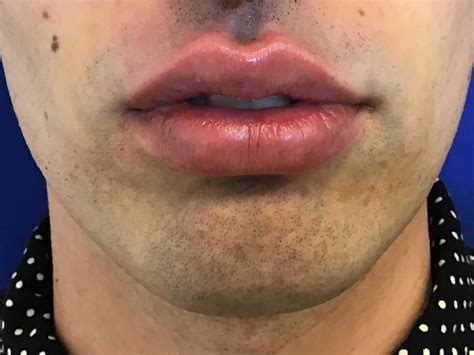 Before And After JuvÉderm® And Lip Filler Photos