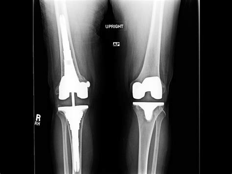 Ortho Dx Complications After Total Knee Arthroplasty Clinical Advisor