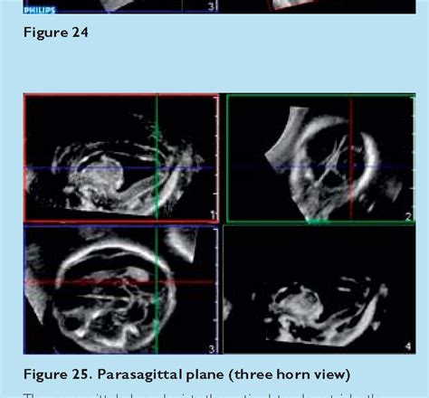 Figure 25 From An Introduction To Fetal Neurosonography Using Three