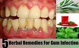 Images of At Home Gum Disease Treatment