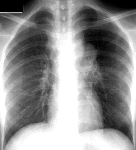 Tuberculosis A Radiologic Review Radiographics