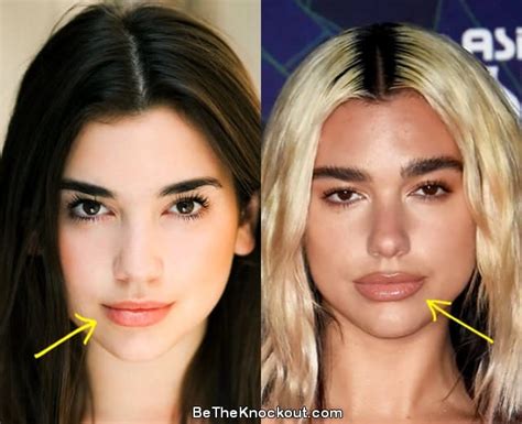 Dua Lipa Plastic Surgery Comparison Photos