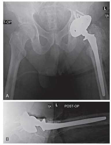Periprosthetic Osteolysis Musculoskeletal Key