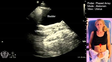 Basic Evaluation Of Pelvic Anatomy Female Using Ultrasound Youtube