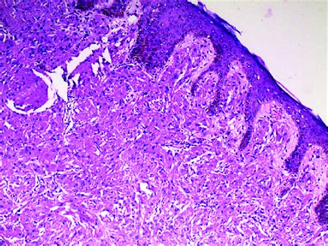 Broad Fascicles Of Large Polygonal Tumor Cells Arranged In Nests Or