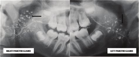 Sialogram Of Parotid Glands Of Patient With Juvenile Recurrent