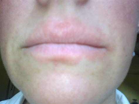 How I Healed The Rash Around My Mouth Lip Allergy Skin Allergies