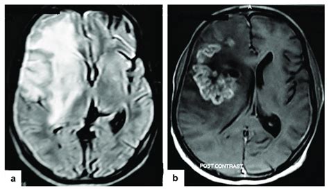 Tuberculous Cerebritis In An Adult Man With Fever And Seizures A