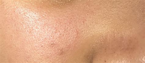 Skin Concerns Whats Wrong With My Face Are These Clogged Enlarged