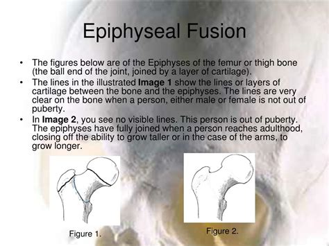 Epiphyseal Fusion The Process Of Cartilage Replacement By Bone Tissue