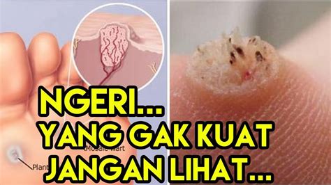 Nah, itu dia 7 cara menghilangkan mata ikan yang bisa kamu terapkan secara alami tanpa harus operasi. Cara Mengatasi Mata Ikan Dengan Cepat Dan Aman - YouTube